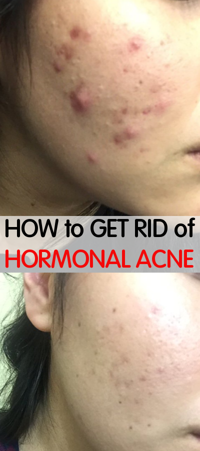 How to get rid of Hormonal Acne