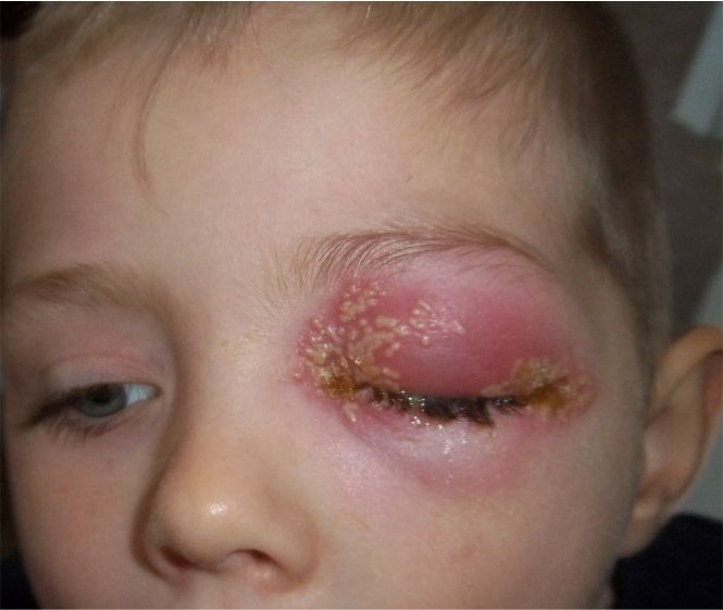 herpes simplex eye disease - uthscsa.edu