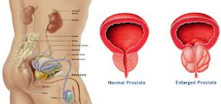 obat herbal yang aman untuk menyembuhkan kanker prostat obat herbal yang aman untuk menyembuhkan kanker prostat