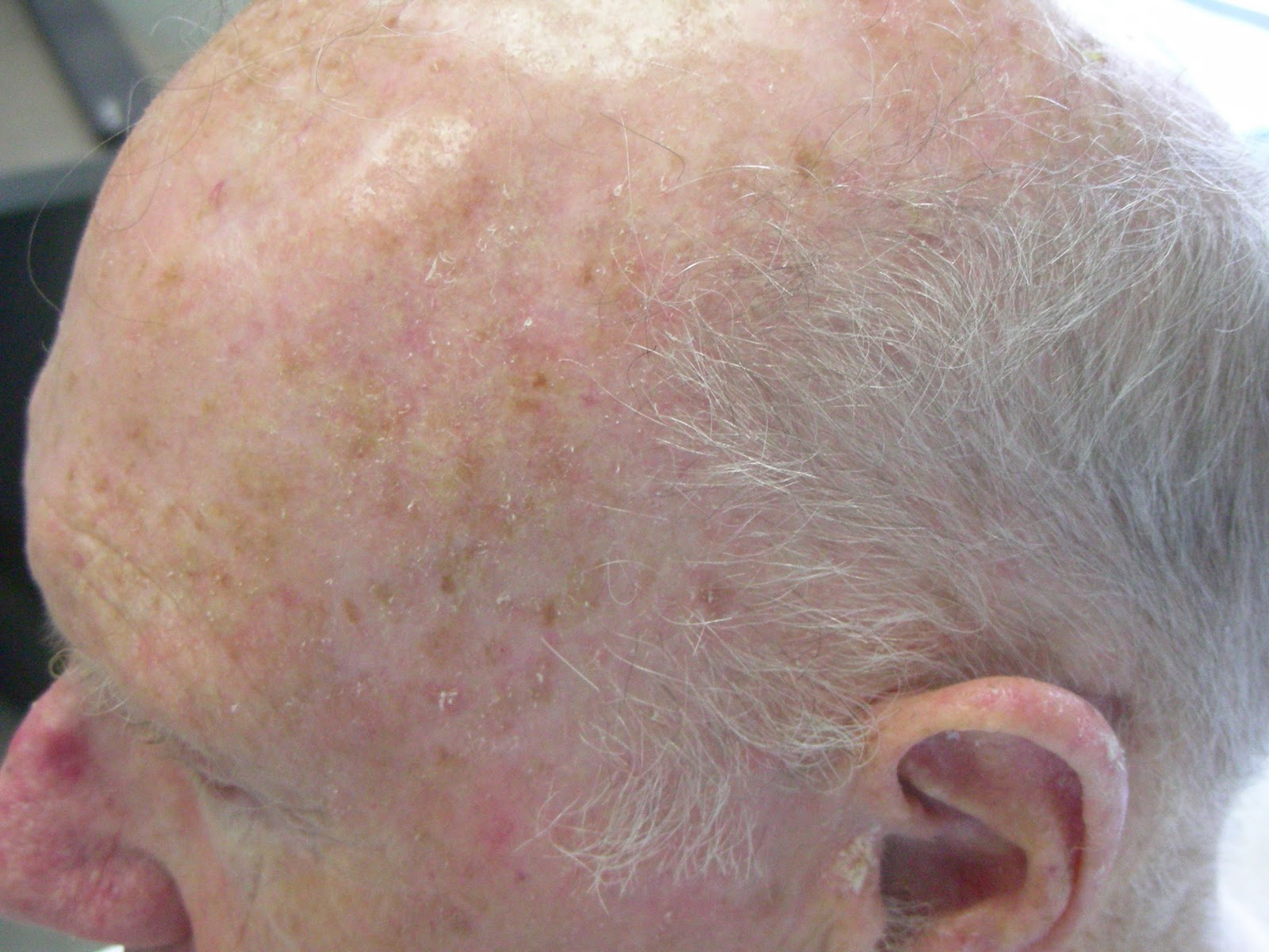 health-from-trusted-sources-actinic-keratoses