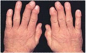 reumatismo palindromico cura medicamente pentru artrita articulațiilor mâinilor