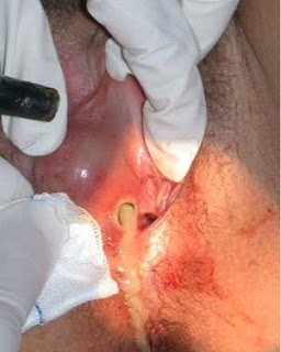 Bartholin cyst is caused due to the block in the Bartholin glands. 