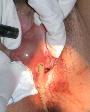Excision of vaginal cysts