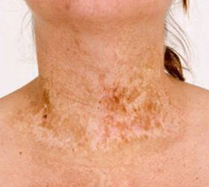 old burn scars old burn scars