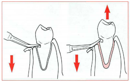重新載圖下圖中之器械 題組 53 是何種拔牙工具 A No 9 Pe 阿摩線上測驗
