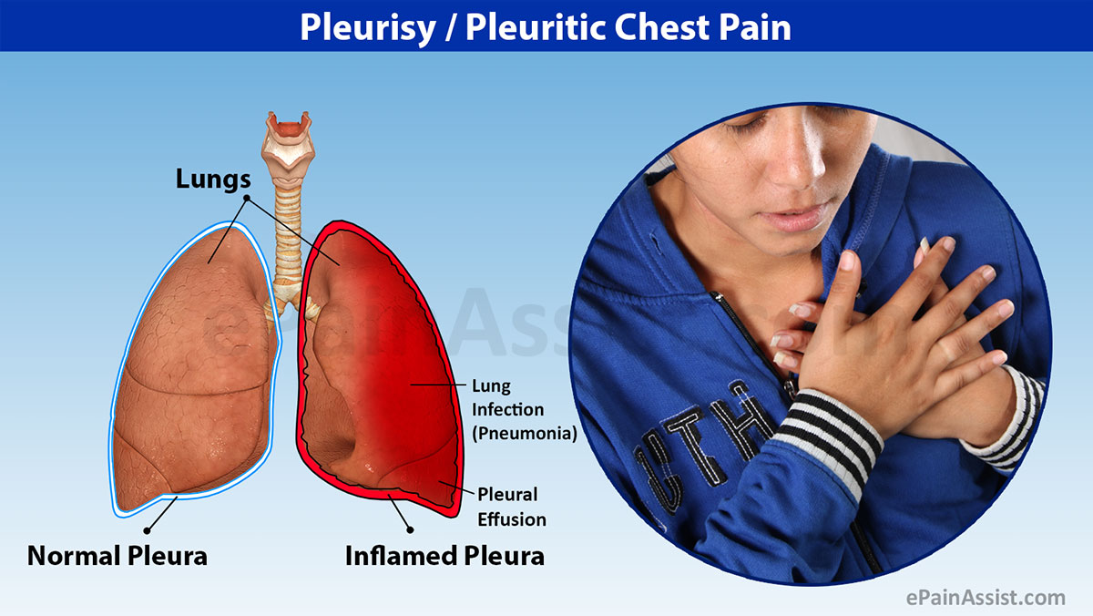 Penyakit Pleuritis Gejala Dan Penyebabnya penyakit-pleuritis-gejala-dan-penyebabnya
