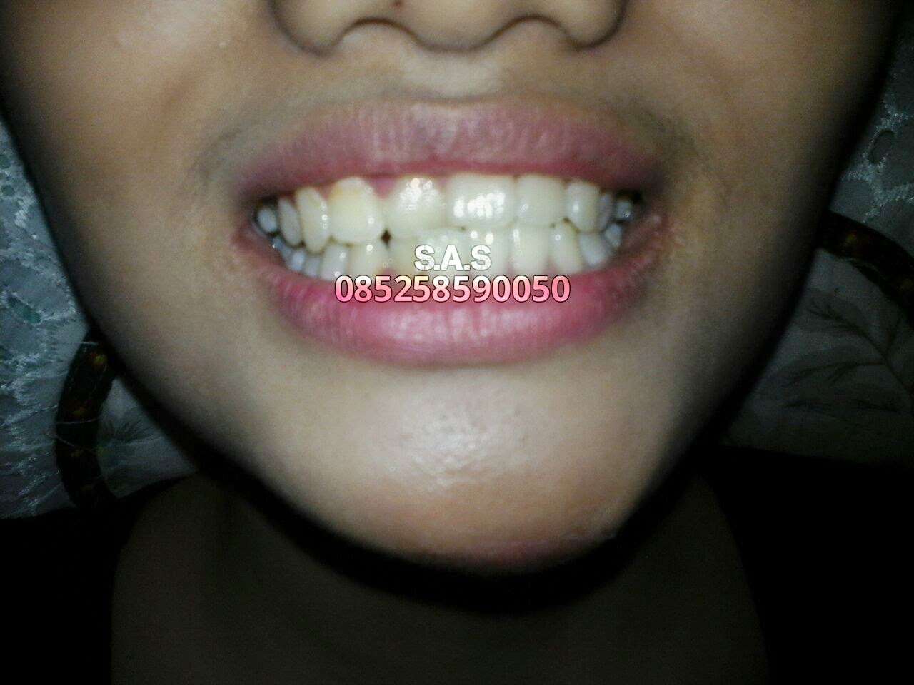 Cara dan Metode S.A.S Kota Jember Merapikan Susunan Gigi Tanpa Kawat ...