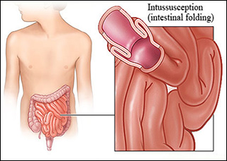 intussusception, small intestine