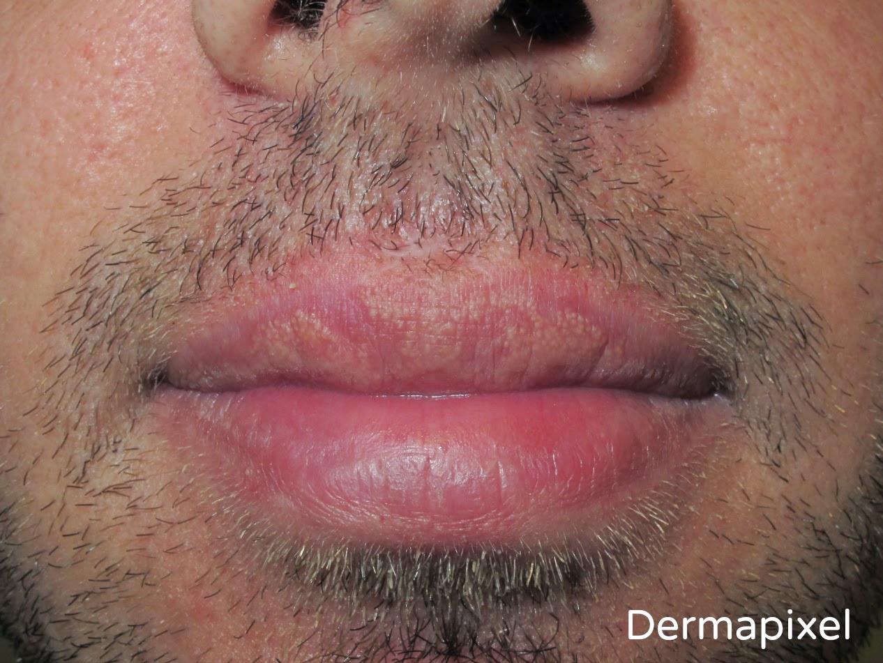 images of herpes on lips #11