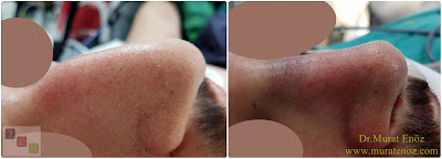 Erkek burun estetiği modelleri - Erkek burun estetiği öncesi ve sonrası - Erkek burun estetiği görüntüleri - Erkek burun estetiği fotoğrafları - Erkek burun estetiği fiyatları - Erkek burun estetiği nasıl olmalı? - Erkeklerde burun estetiği - Erkeklerde rinoplasti operasyonu - Rhinoplasty in men Istanbul - Rhinoplasty for men in Turkey - Male rhinoplasty Istanbul - Nose job in men Istanbul Erkek burun estetiği modelleri - Erkek burun estetiği öncesi ve sonrası - Erkek burun estetiği görüntüleri - Erkek burun estetiği fotoğrafları - Erkek burun estetiği fiyatları - Erkek burun estetiği nasıl olmalı? - Erkeklerde burun estetiği - Erkeklerde rinoplasti operasyonu - Rhinoplasty in men Istanbul - Rhinoplasty for men in Turkey - Male rhinoplasty Istanbul - Nose job in men Istanbul