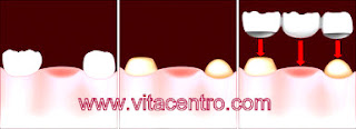 implantes de dentes