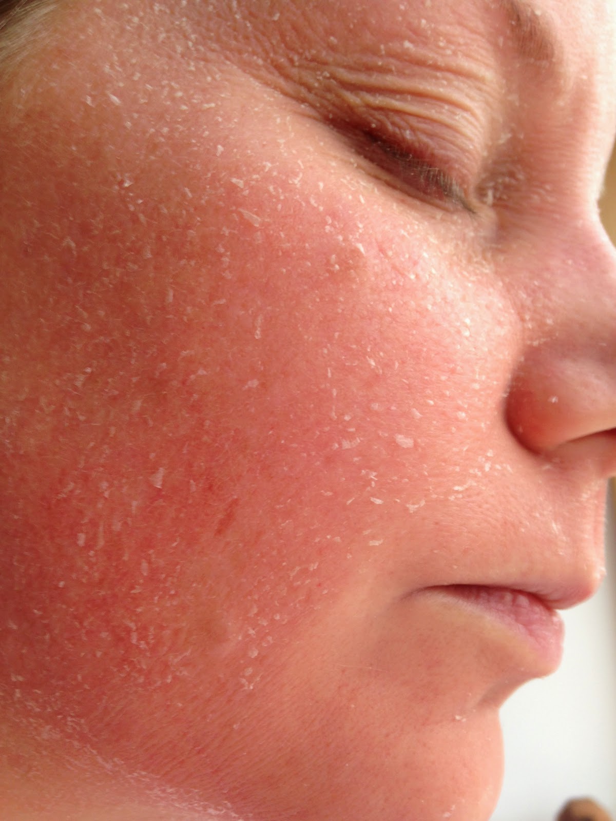 My Obagi Nu-Derm experience : Week 2 - My face is settling to a pink ...