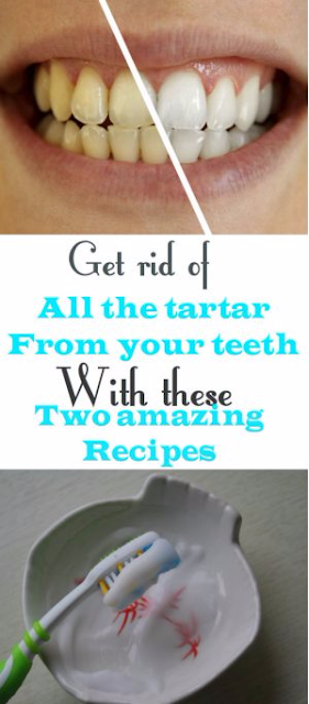 Get Rid Of All The Tartar From Your Teeth With These Two Amazing Recipes