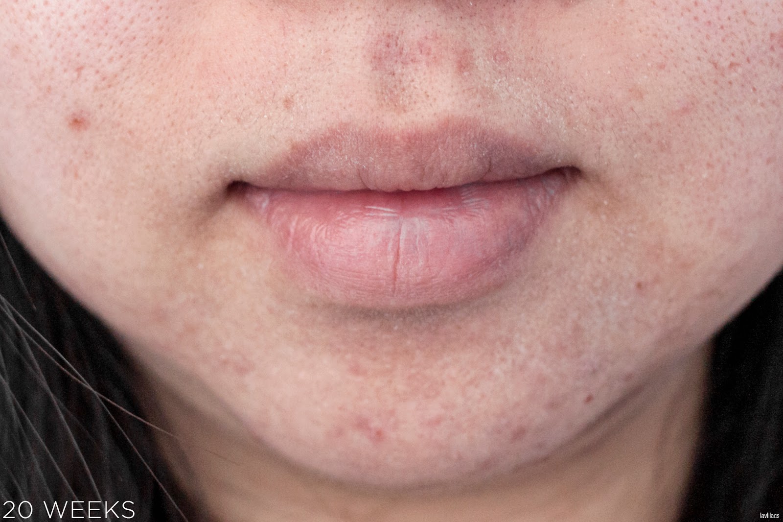 tria Hair Removal Laser Facial Hair 20 Weeks Closeup