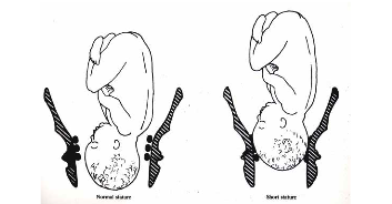 Bayi Agar Bayi Masuk Panggul