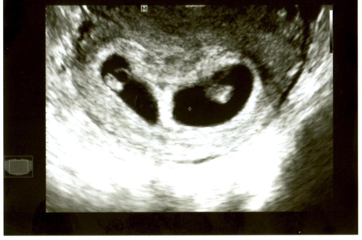 TTC Baby P On TWINS!