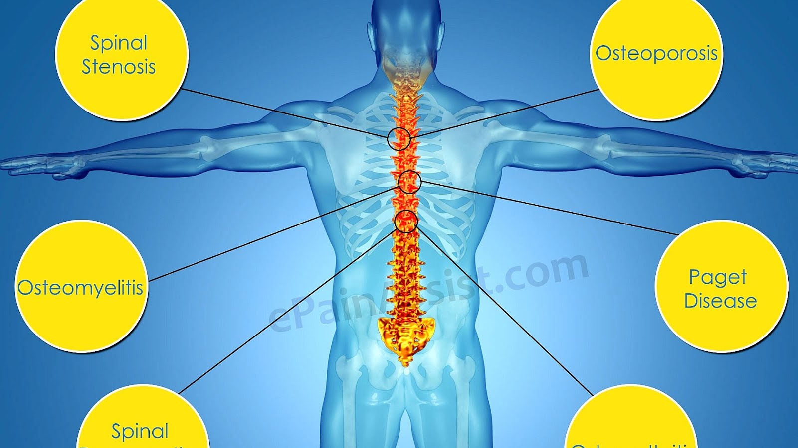 Osteoarthritis Lower Back Pain Icd 10 at Elisa Smith blog