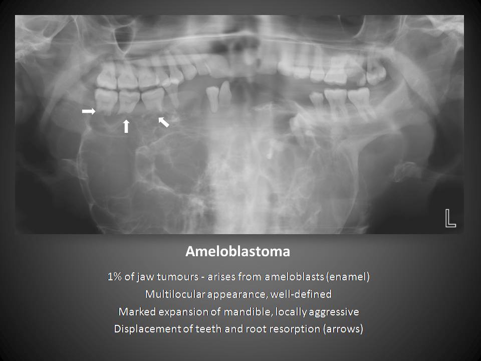 WizDent Ameloblastoma showing multilocular radilolucency