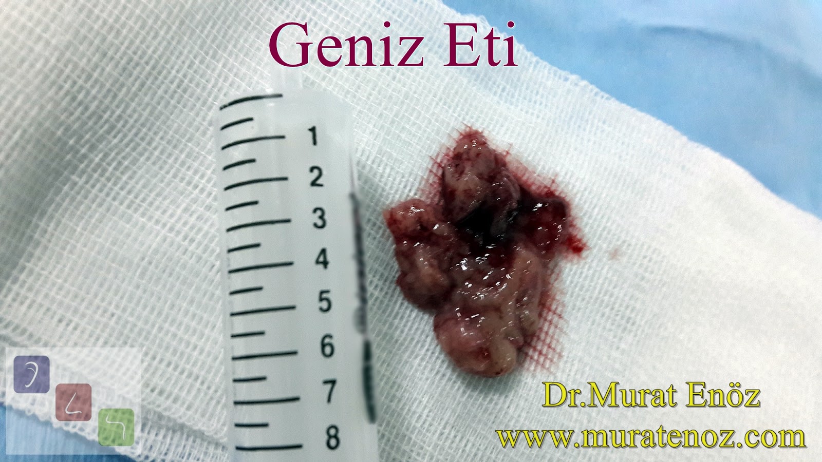 Geniz Eti Büyümesi, Nedenleri, Belirtileri, Tedavisi ve Geniz Eti