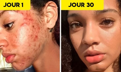 A Woman Got Rid Of Her Acne In 30 Days, Her Method Now Helps Thousands Of People.