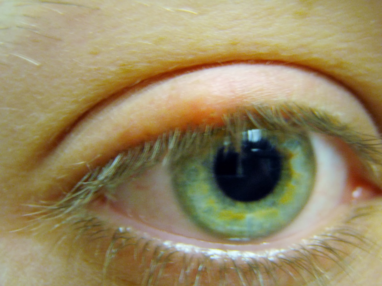 Red Bump on Lash Line Ingrown Eyelash Pictures, Treatments and Prevention