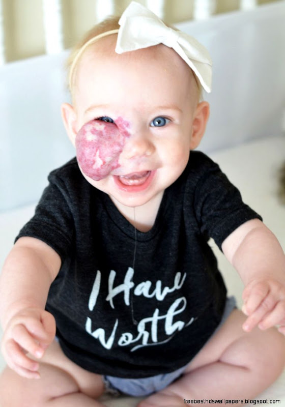 We wont use plastic surgery to remove our babys birthmark  New