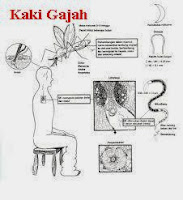 Penyakit Kaki Gajah Obat Kaki Gajah
