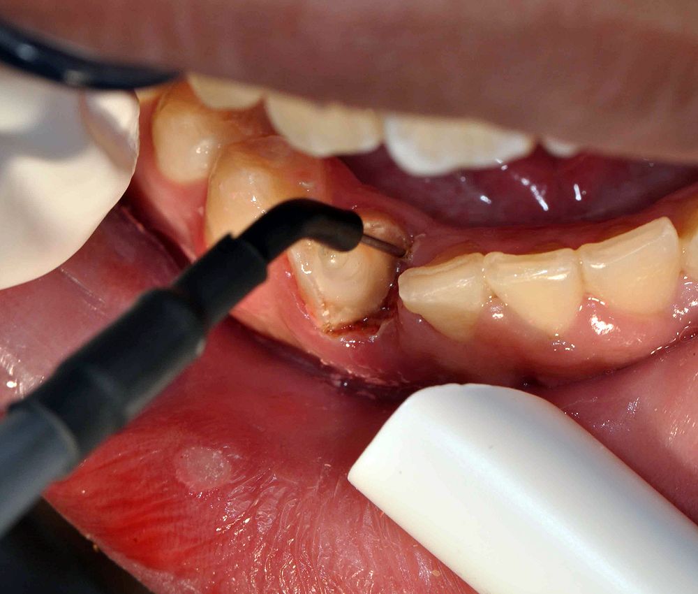 ORAL SURGERY What is Cauterization? Directorio Odontológico