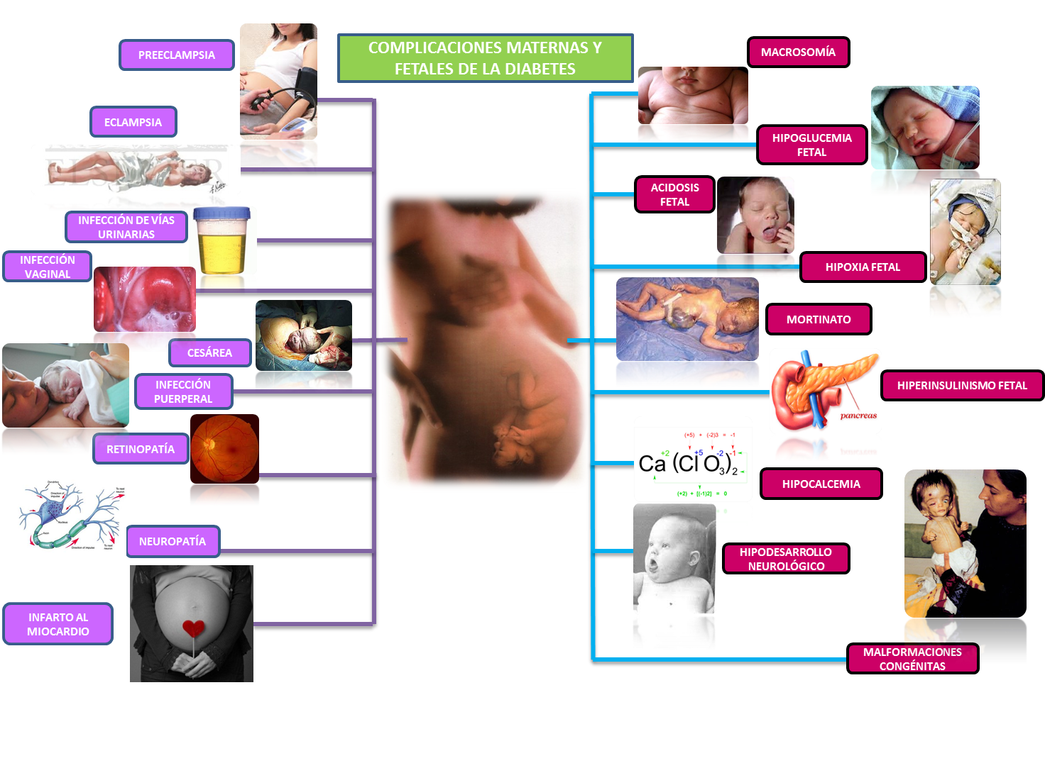 Ginecología y Obstetricia: Mapa Conceptual  Diabetes Gestacional