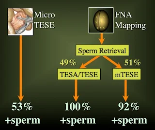  Pemetaan Sperma Untuk Azoospermia (Testicular Mapping / FNA Mapping)