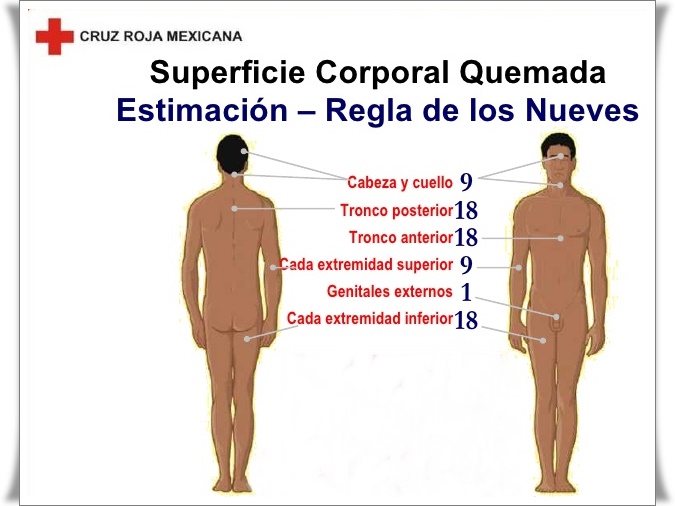 Regla De Los 9 En Quemaduras Ejemplos Opciones de Ejemplo Regla De Los 9 En Quemaduras Ejemplos Opciones de Ejemplo