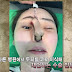 Phẫu thuật thẩm mỹ hỏng, cô gái Hàn Quốc nhận hậu quả đáng sợ