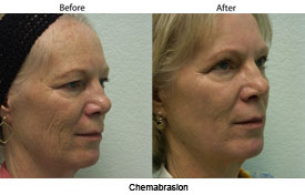 Chemabrasion Skin Resurfacing in Santa Barbara