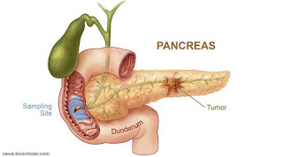 Cara Mengobati Kanker Pankreas