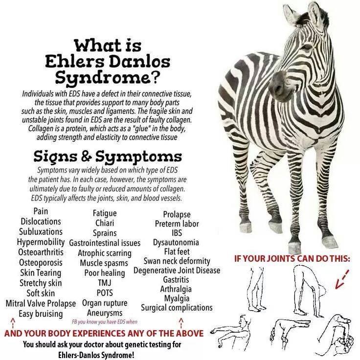 Hypermobility syndrome beighton ehlers danlos ehlersdanlos I HATE Postural Orthostatic Tachycardia : Joint Hypermobility Syndrome