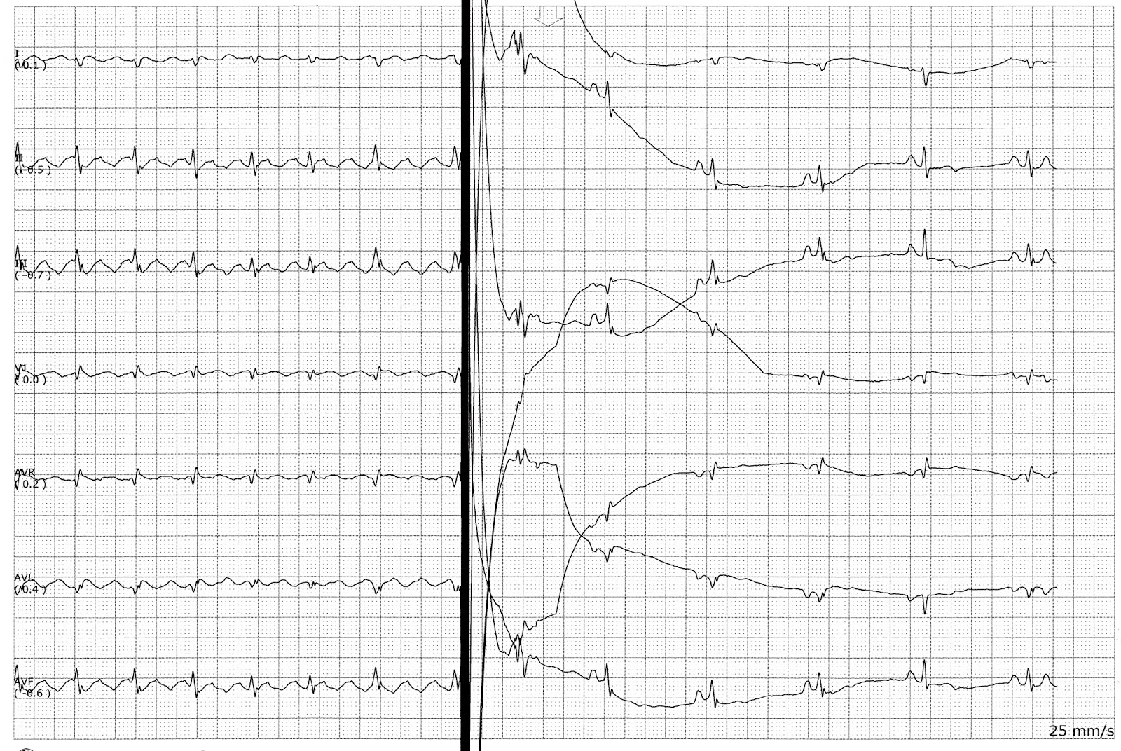 unspecified atrial flutter icd 10 unspecified atrial flutter icd 10
