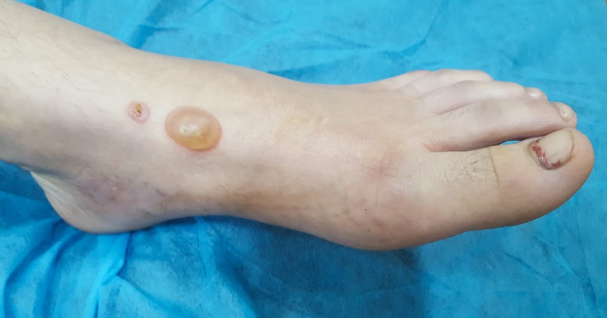 Dermatology Made Easy Bullous Insect Bite