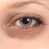 مرض جلدي شائع (الهالات القاتمة) حول العينين
