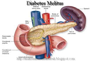 Obat Diabetes Melitus Herbal Alami