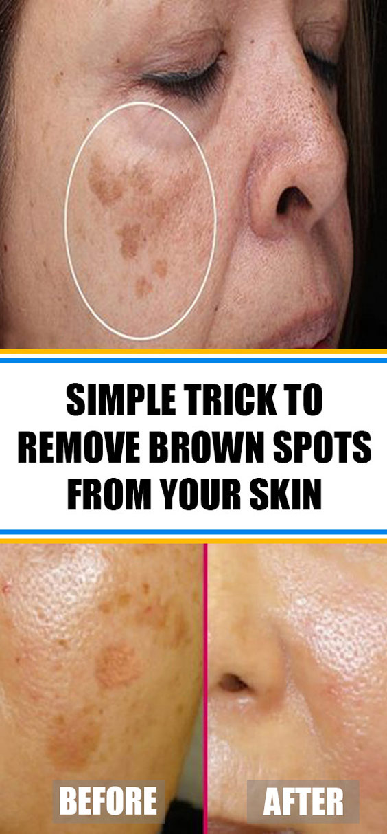 Simple Trick To Remove Brown Spots From Your Skin