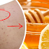 Amazing Home Remedies to Get Rid of Back Acne