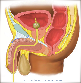 peaceful parenting: Urine Samples and Catheter Insertion ...