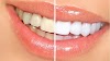How to Whiten Teeth Naturally at Home