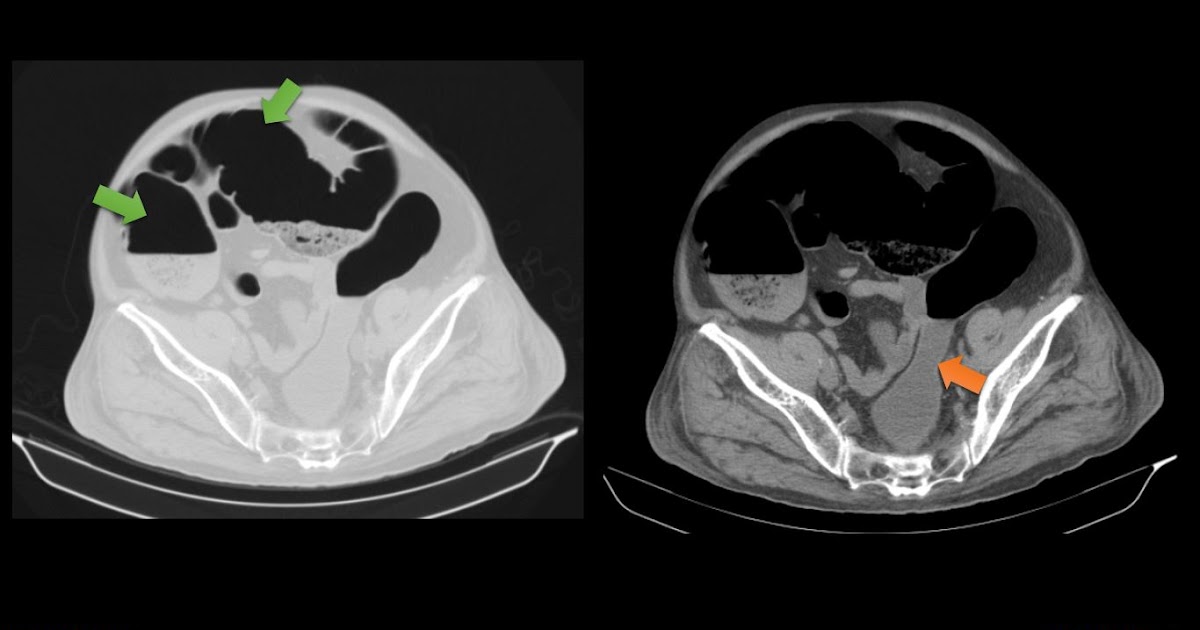 Ultimate Radiology Ogilvie Syndrome or Acute Colonic Pseudo Obstruction