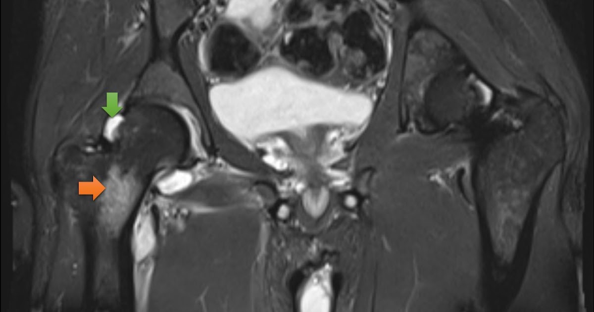 Ultimate Radiology Septic arthritis of hip joint