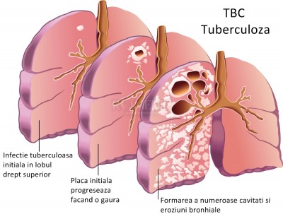 Tuberculoza urogenitala