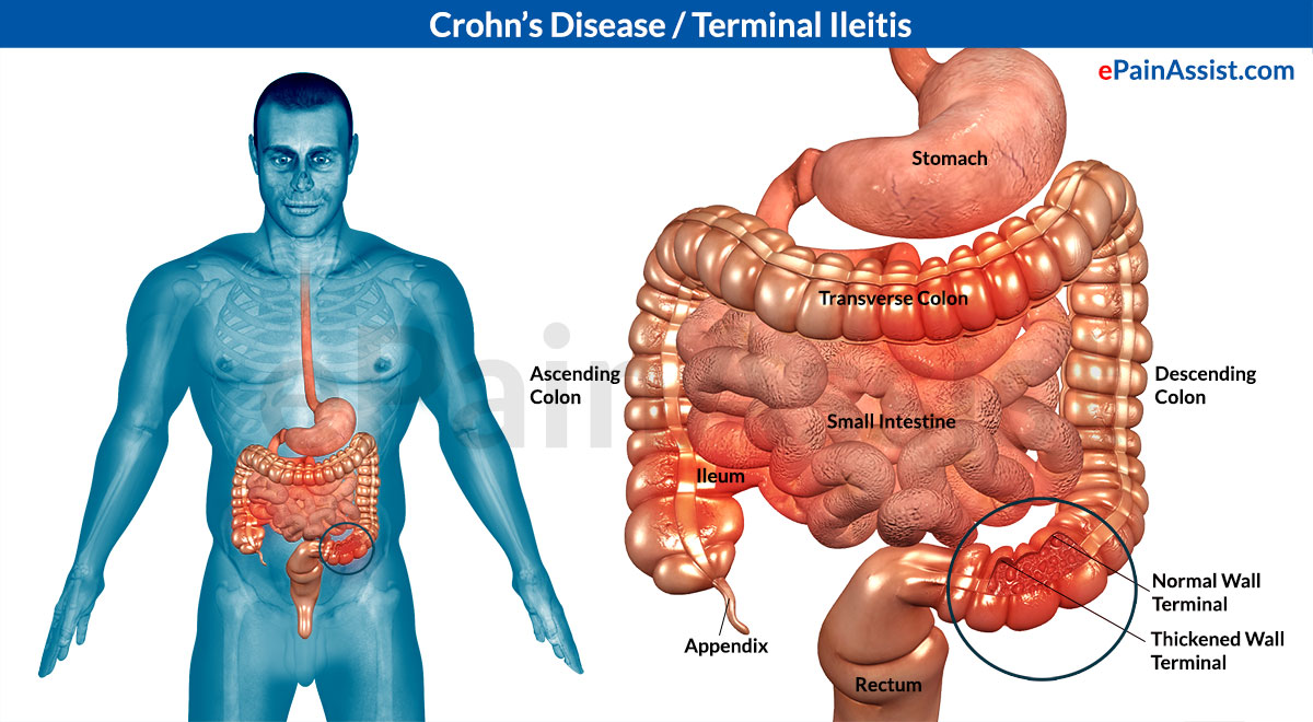 Crohn's Disease Symptoms, Causes and Treatment Health Secrets and Tips