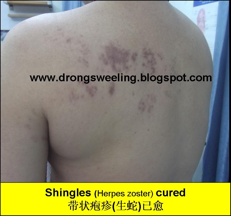 TCM News Best TCM Doctor for Shingles, Herpes Zoster, Postherpetic Neuralgia