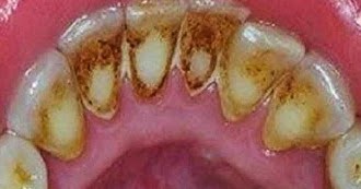 Cara Mudah Menghilangkan Karang Gigi Tanpa Harus Ke Dokter 