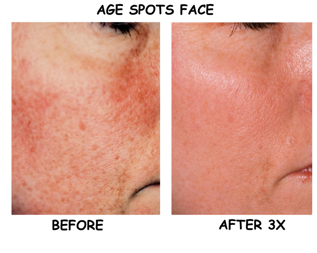 Kashyap Skin Clinic Best Dermatologist In Dwarka New Delhi Age Spot kashyap-skin-clinic-best-dermatologist-in-dwarka-new-delhi-age-spot